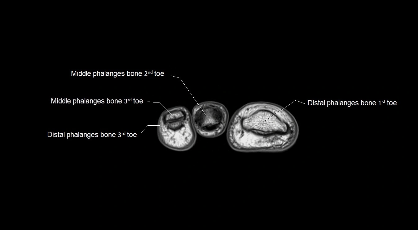 MRI 3T foot axial cross sectional anatomy image 39.webp